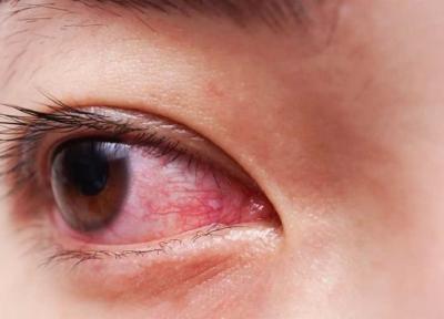 چرا چشم هایمان قرمز می شوند؟ ، 11 علت مهم قرمزی را بخوانید